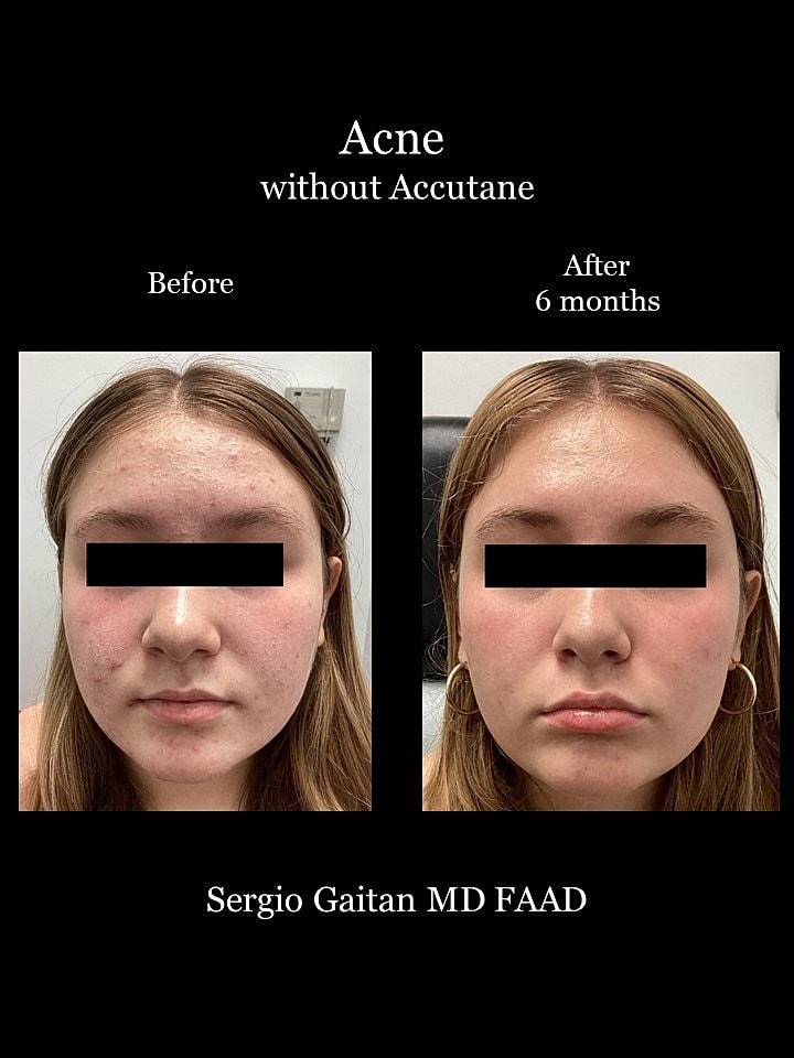 Acne Before & After
