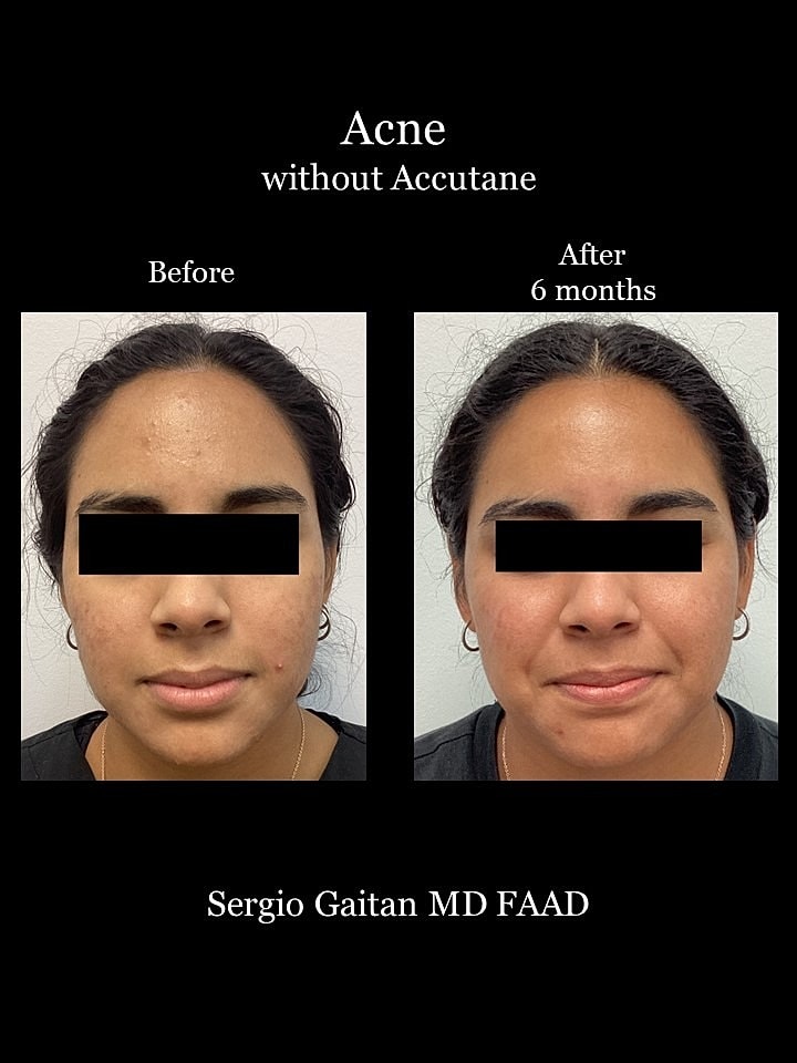 Acne Before & After