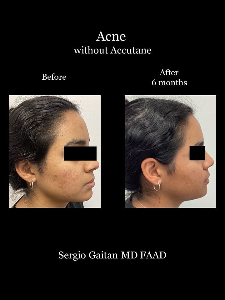 Acne Before & After
