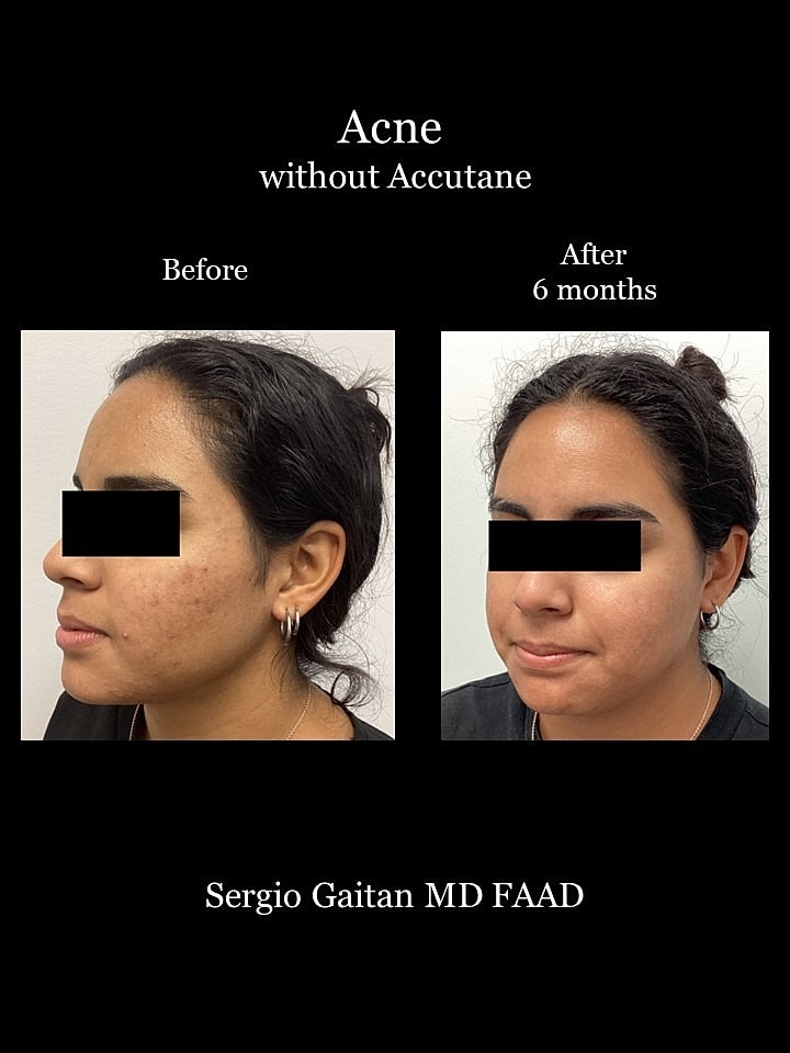 Acne Before & After