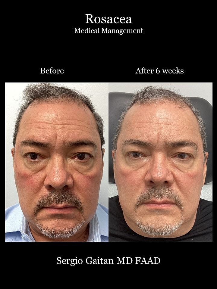 Rosacea Before & After