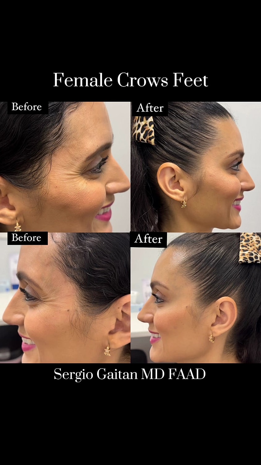 Before and after crows feet treatment comparison