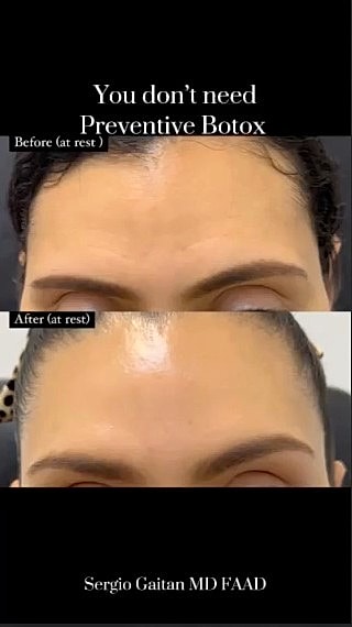 Botox results comparison: before and after treatment.